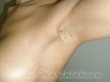 Рубец после эндоскопического увеличения груди в подмышечной области