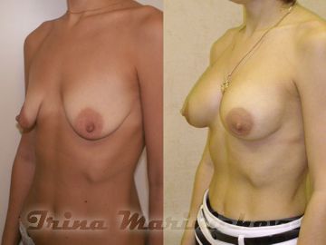 Подтяжка груди - фото до и после
