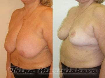 Редукционная маммопластика - фото до и после