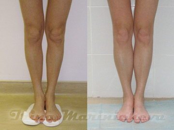 Пластика голеней - фото до и после