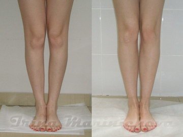 Пластика голеней - фото до и после