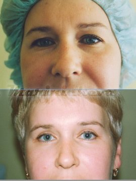 Блефаропластика - фото до и после