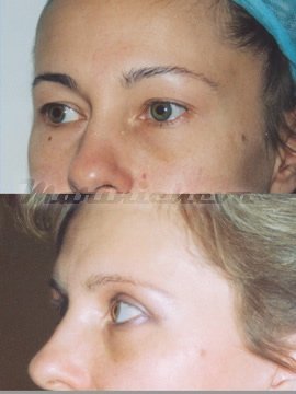Блефаропластика - фото до и после