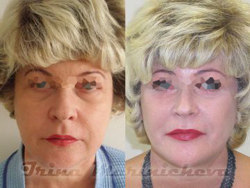 Подтяжка лица, СМАС лифтинг - фото до и после