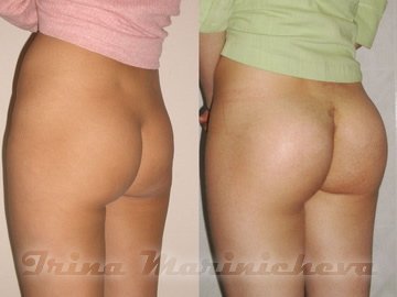 Уменьшение груди - фото до и после