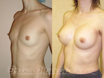 Маммопластика подмышечным доступом - фото до и после
