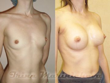 Увеличение груди - фото до и после