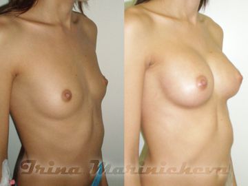 Увеличение груди - фото до и после