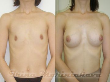 Эндоскопическая маммопластика - фото до и после
