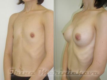 Маммопластика подмышечным доступом - фото до и после