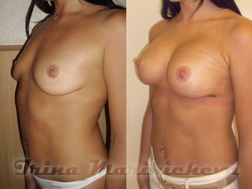 Увеличение птозированной груди - фото до и после