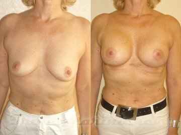 Асимметрия груди - фото до и после