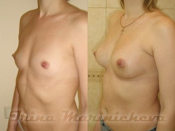 Маммопластика - фото до и после