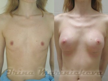 Маммопластика - фото до и после