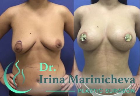 Маммопластика периареолярным доступом - фото до и после