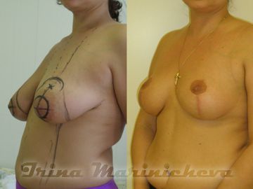 Коррекция ареолы приподтяжке груди - фото до и после