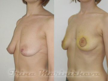 Циркулярная мастопексия - фото до и после