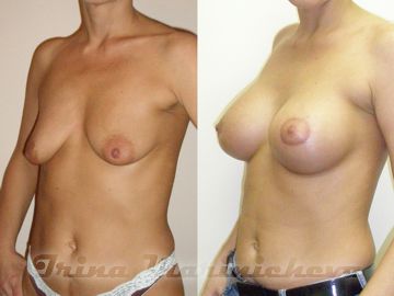 Подтяжка груди - фото до и после