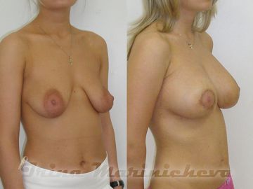 Увеличение груди с уменьшением ареолы