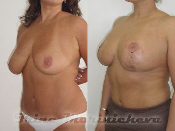Редукционная маммопластика - фото до и после